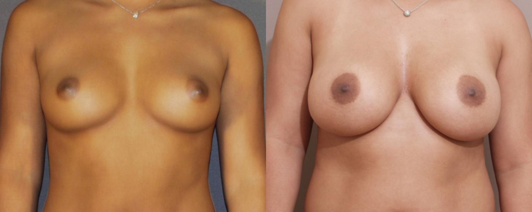 Breast Augmentation Case 69 Before & After View #1 | Webster, TX | Houston Plastic and Reconstructive Surgery