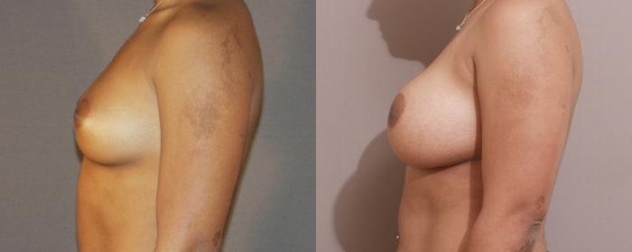 Breast Augmentation Case 69 Before & After View #2 | Webster, TX | Houston Plastic and Reconstructive Surgery