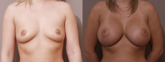 Breast Augmentation Case 70 Before & After View #1 | Webster, TX | Houston Plastic and Reconstructive Surgery