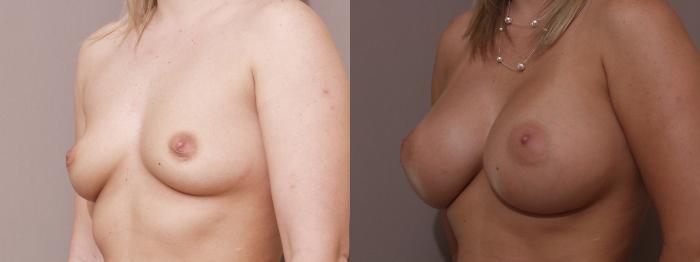 Breast Augmentation Case 70 Before & After View #2 | Webster, TX | Houston Plastic and Reconstructive Surgery
