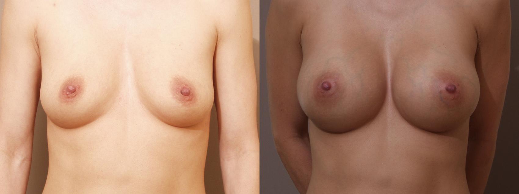 Breast Augmentation Case 84 Before & After View #1 | Webster, TX | Houston Plastic and Reconstructive Surgery