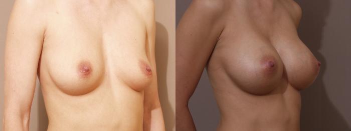 Breast Augmentation Case 84 Before & After View #2 | Webster, TX | Houston Plastic and Reconstructive Surgery
