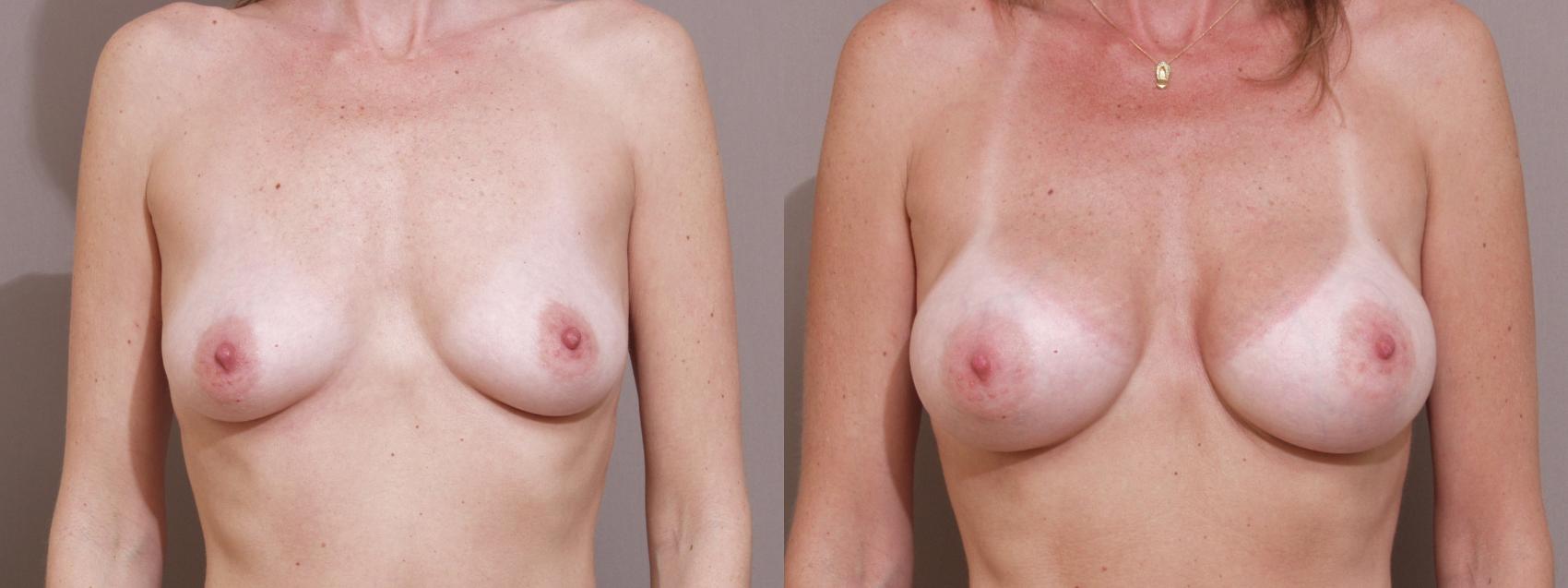 Breast Augmentation Case 88 Before & After View #1 | Webster, TX | Houston Plastic and Reconstructive Surgery