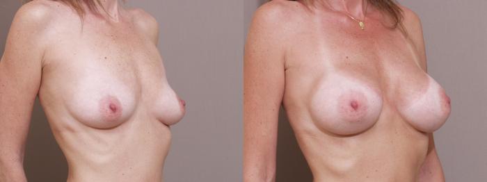 Breast Augmentation Case 88 Before & After View #2 | Webster, TX | Houston Plastic and Reconstructive Surgery
