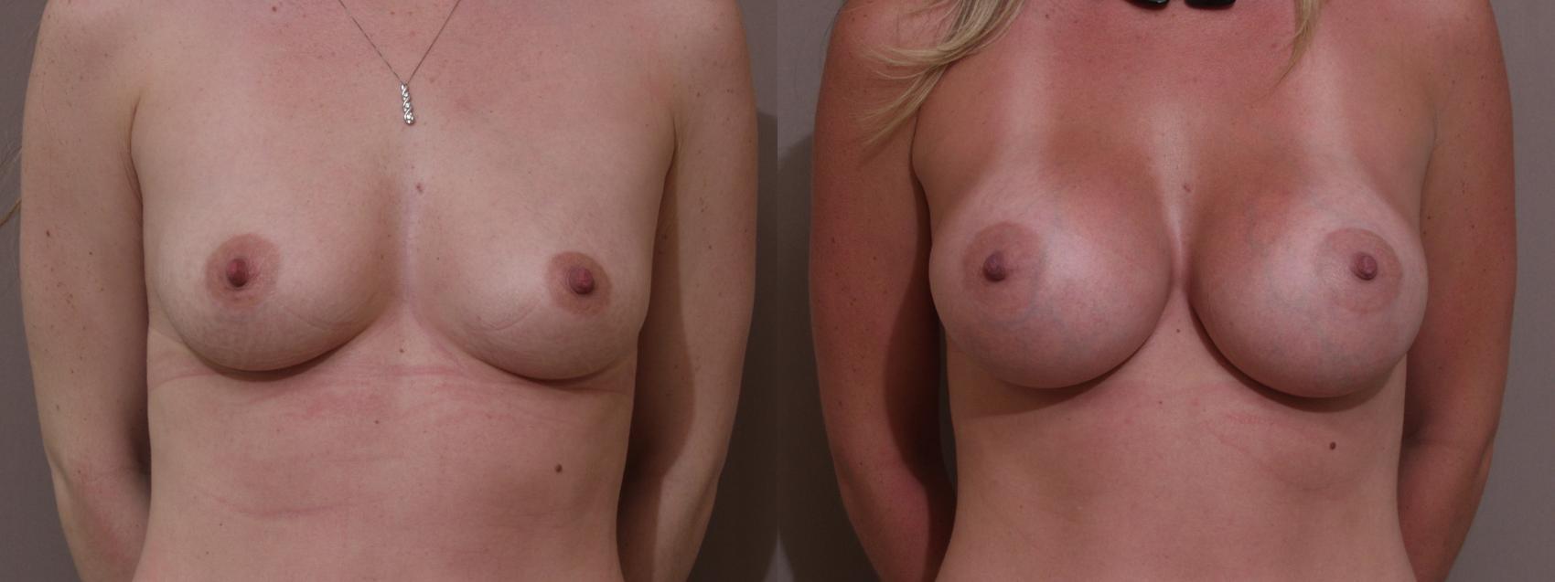 Breast Augmentation Case 92 Before & After View #1 | Webster, TX | Houston Plastic and Reconstructive Surgery