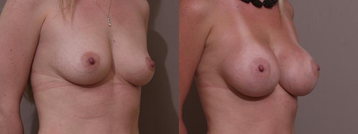 Breast Augmentation Case 92 Before & After View #2 | Webster, TX | Houston Plastic and Reconstructive Surgery