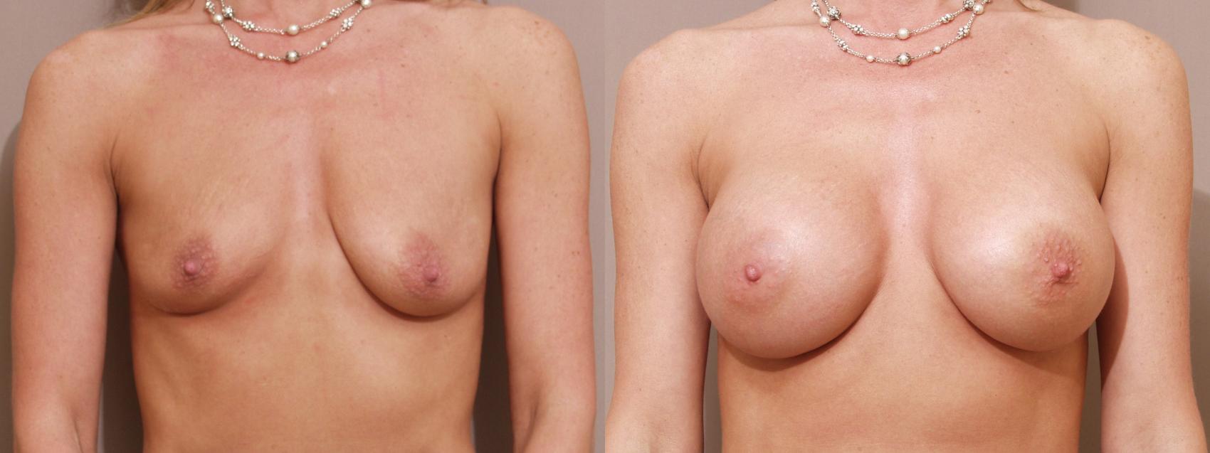 Breast Augmentation Case 99 Before & After View #1 | Webster, TX | Houston Plastic and Reconstructive Surgery