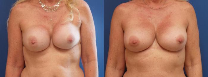 Breast Implant Exchange Case 281 Before & After View #1 | Webster, TX | Houston Plastic and Reconstructive Surgery