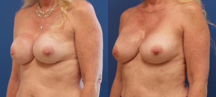 Breast Implant Exchange Case 281 Before & After View #2 | Webster, TX | Houston Plastic and Reconstructive Surgery