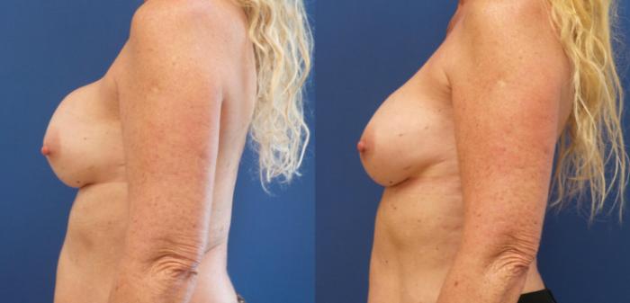 Breast Implant Exchange Case 281 Before & After View #3 | Webster, TX | Houston Plastic and Reconstructive Surgery
