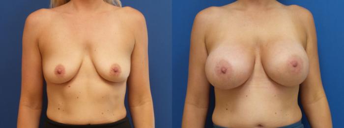 Breast Implant Exchange Case 287 Before & After Front | Webster, TX | Houston Plastic and Reconstructive Surgery
