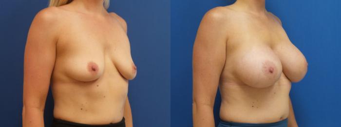 Breast Implant Exchange Case 287 Before & After Right Oblique | Webster, TX | Houston Plastic and Reconstructive Surgery