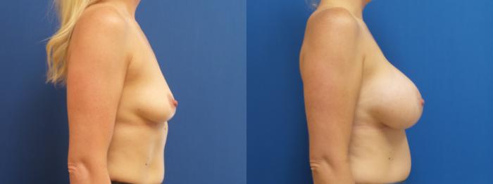 Breast Implant Exchange Case 287 Before & After Right Side | Webster, TX | Houston Plastic and Reconstructive Surgery
