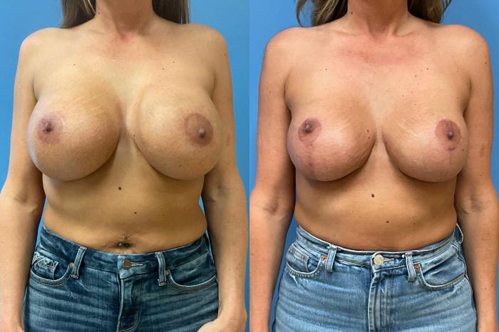 Breast Implant Exchange Case 301 Before & After Front | Webster, TX | Houston Plastic and Reconstructive Surgery