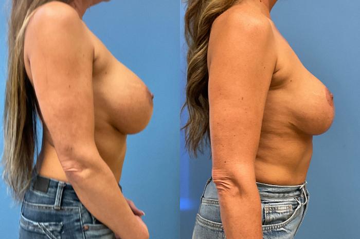 Breast Lift Case 301 Before & After Right Side | Webster, TX | Houston Plastic and Reconstructive Surgery