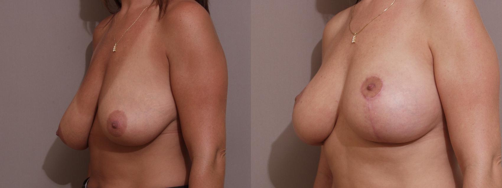 Breast Lift Case 123 Before & After View #1 | Webster, TX | Houston Plastic and Reconstructive Surgery