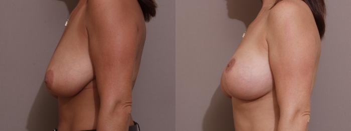 Breast Lift Case 123 Before & After View #2 | Webster, TX | Houston Plastic and Reconstructive Surgery