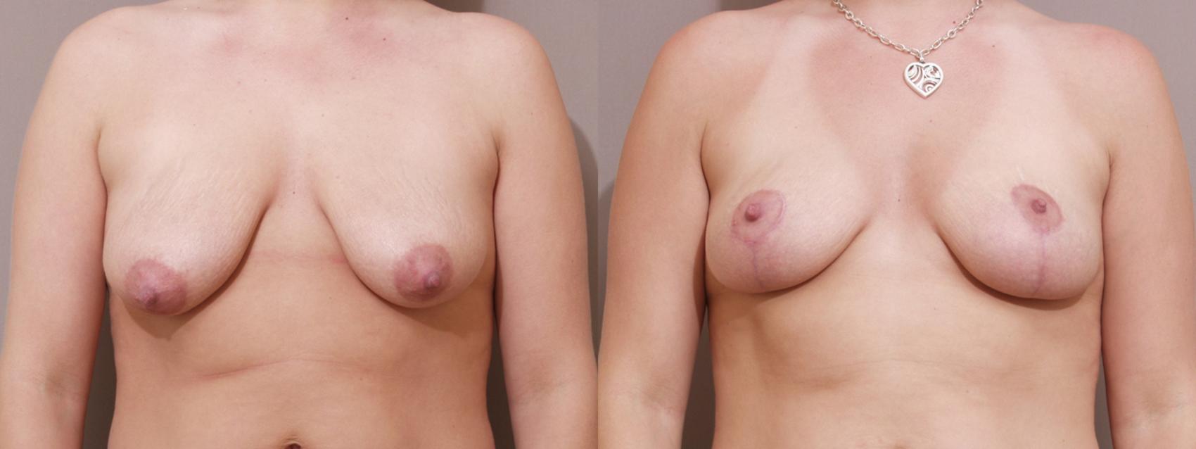 Breast Lift Case 16 Before & After View #1 | Webster, TX | Houston Plastic and Reconstructive Surgery