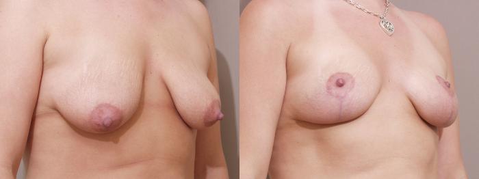 Breast Lift Case 16 Before & After View #2 | Webster, TX | Houston Plastic and Reconstructive Surgery