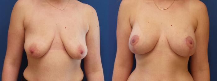 Breast Lift Case 217 Before & After View #1 | Webster, TX | Houston Plastic and Reconstructive Surgery