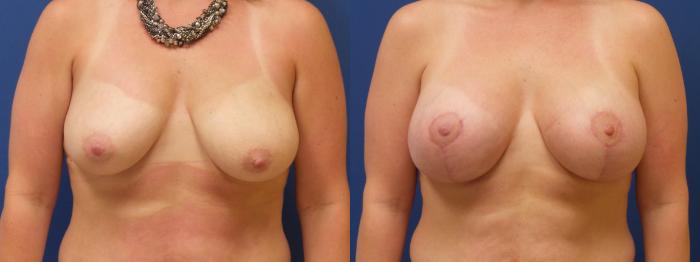 Breast Lift Case 219 Before & After View #1 | Webster, TX | Houston Plastic and Reconstructive Surgery