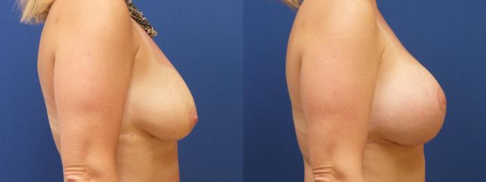 Breast Lift Case 219 Before & After View #2 | Webster, TX | Houston Plastic and Reconstructive Surgery