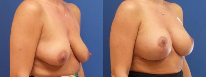 Breast Lift Case 220 Before & After View #1 | Webster, TX | Houston Plastic and Reconstructive Surgery