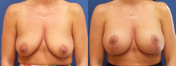 Breast Lift Case 220 Before & After View #2 | Webster, TX | Houston Plastic and Reconstructive Surgery