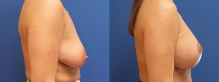 Breast Lift Case 220 Before & After View #3 | Webster, TX | Houston Plastic and Reconstructive Surgery