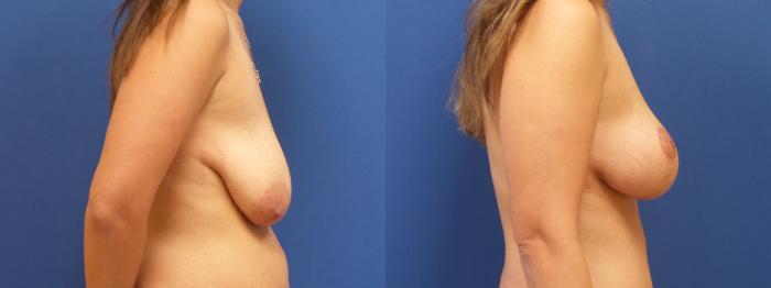 Breast Lift Case 221 Before & After View #1 | Webster, TX | Houston Plastic and Reconstructive Surgery
