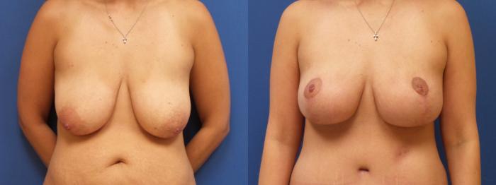 Breast Lift Case 221 Before & After View #2 | Webster, TX | Houston Plastic and Reconstructive Surgery