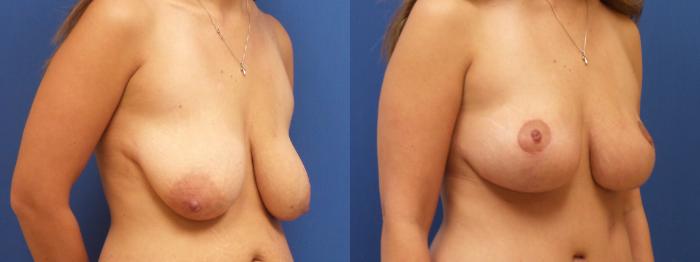 Breast Lift Case 221 Before & After View #3 | Webster, TX | Houston Plastic and Reconstructive Surgery