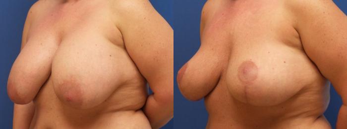 Breast Lift Case 222 Before & After View #1 | Webster, TX | Houston Plastic and Reconstructive Surgery