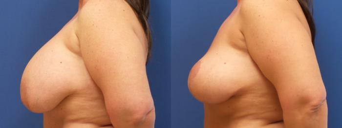 Breast Lift Case 222 Before & After View #2 | Webster, TX | Houston Plastic and Reconstructive Surgery
