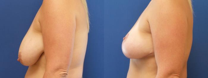 Breast Lift Case 223 Before & After View #1 | Webster, TX | Houston Plastic and Reconstructive Surgery