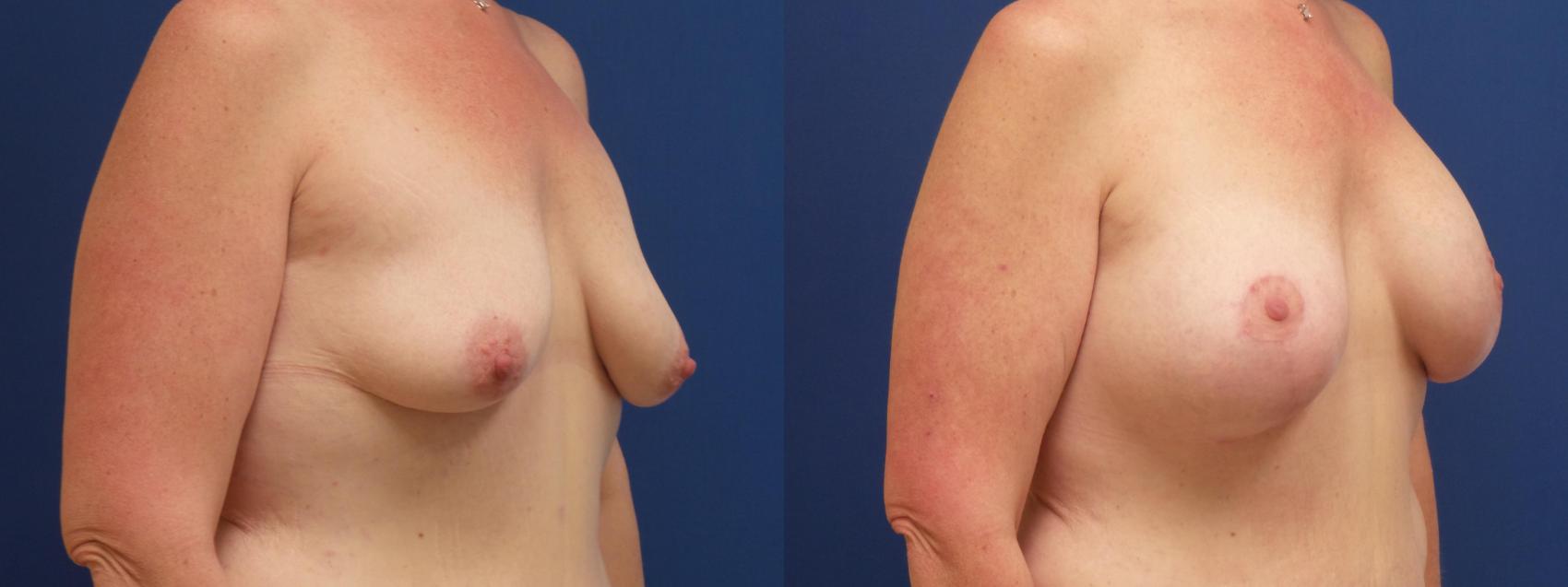 Breast Lift Case 225 Before & After View #1 | Webster, TX | Houston Plastic and Reconstructive Surgery