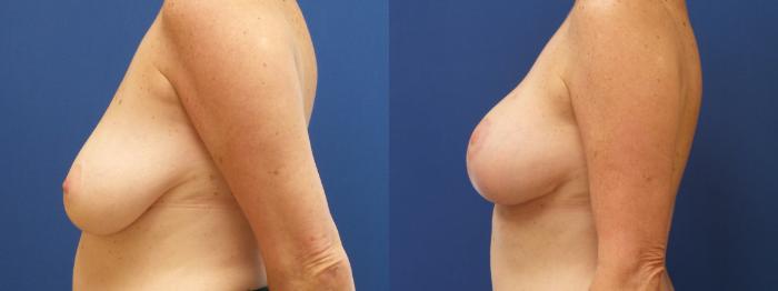 Breast Lift Case 226 Before & After View #1 | Webster, TX | Houston Plastic and Reconstructive Surgery