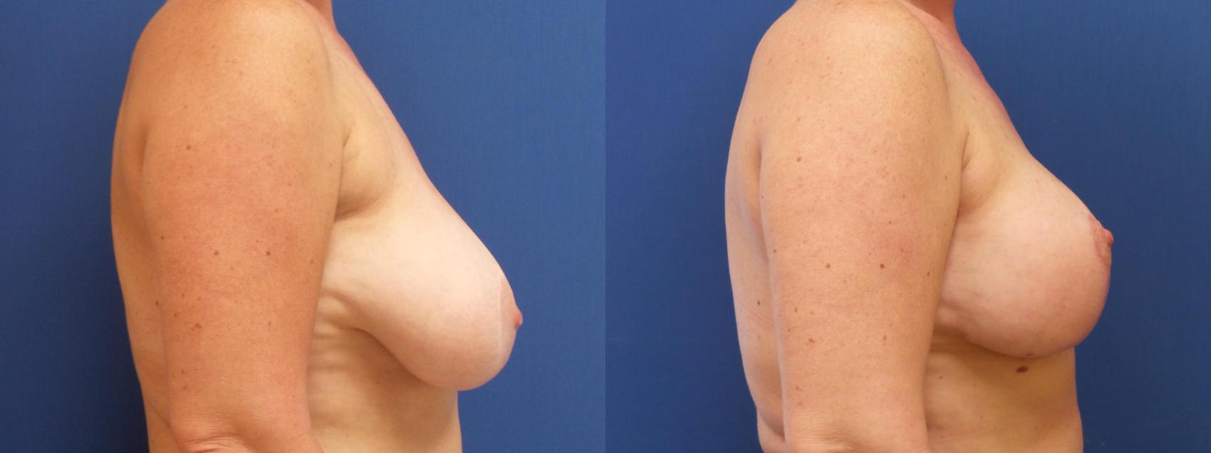 Breast Lift Case 268 Before & After View #1 | Webster, TX | Houston Plastic and Reconstructive Surgery