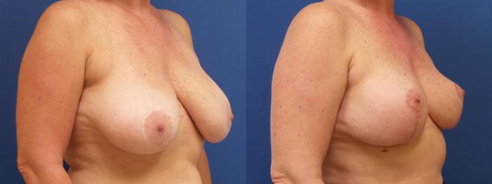 Breast Lift Case 268 Before & After View #2 | Webster, TX | Houston Plastic and Reconstructive Surgery