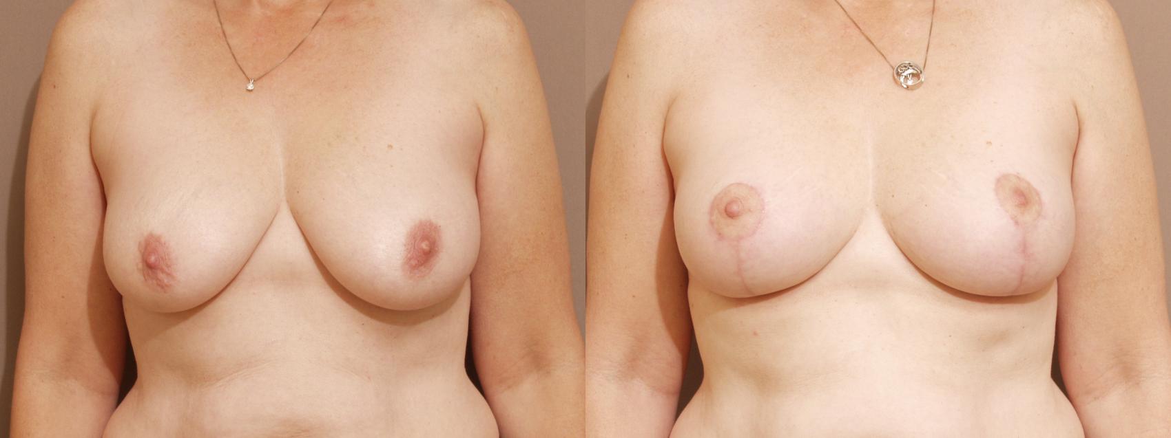 Breast Lift Case 51 Before & After View #1 | Webster, TX | Houston Plastic and Reconstructive Surgery