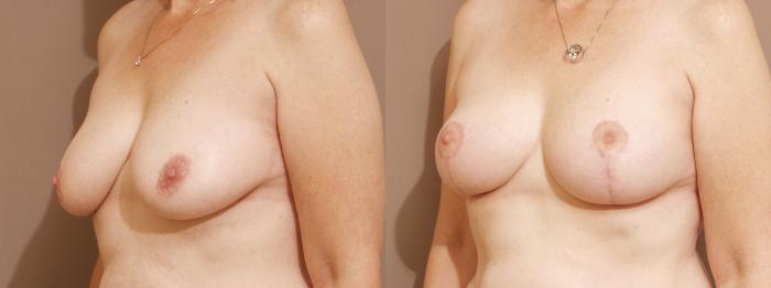 Breast Lift Case 51 Before & After View #2 | Webster, TX | Houston Plastic and Reconstructive Surgery