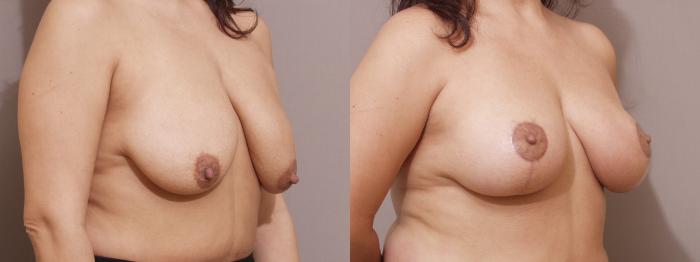 Breast Lift Case 73 Before & After View #2 | Webster, TX | Houston Plastic and Reconstructive Surgery