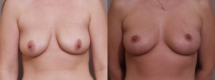 Breast Lift Case 89 Before & After View #1 | Webster, TX | Houston Plastic and Reconstructive Surgery