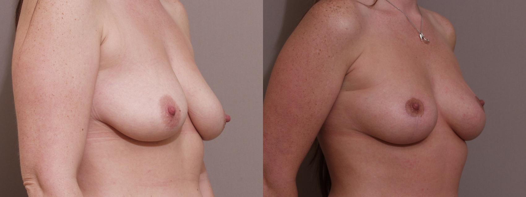Breast Lift Case 89 Before & After View #2 | Webster, TX | Houston Plastic and Reconstructive Surgery