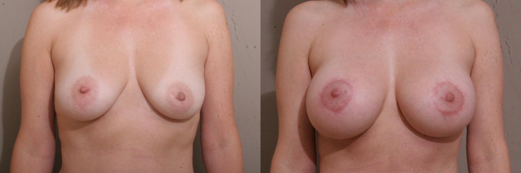 Breast Lift with Implants (Traditional & Donut) Case 108 Before & After View #1 | Webster, TX | Houston Plastic and Reconstructive Surgery