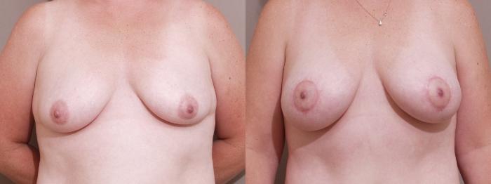Breast Lift with Implants (Traditional & Donut) Case 119 Before & After View #1 | Webster, TX | Houston Plastic and Reconstructive Surgery