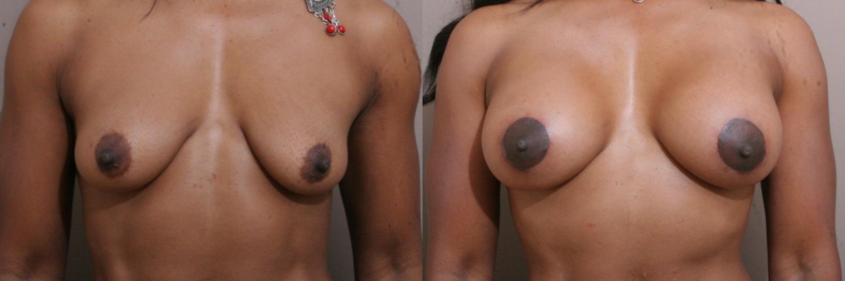Breast Lift with Implants (Traditional & Donut) Case 137 Before & After View #1 | Webster, TX | Houston Plastic and Reconstructive Surgery