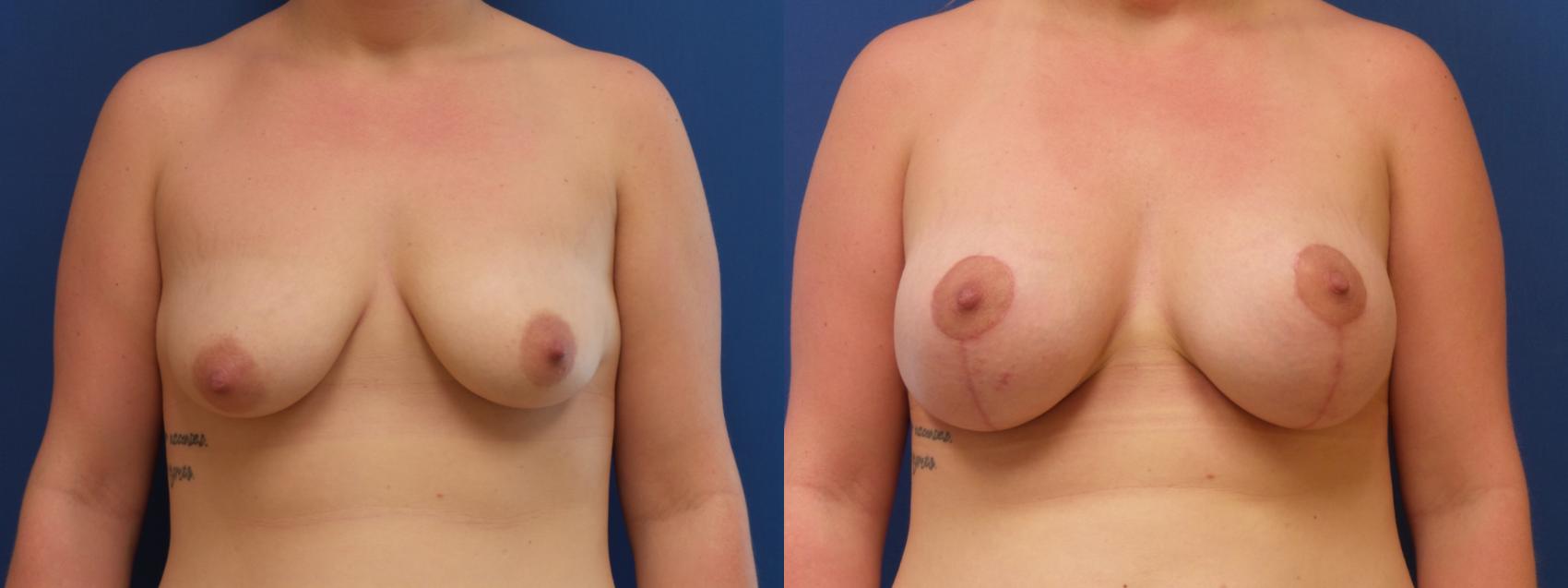 Breast Lift with Implants (Traditional & Donut) Case 144 Before & After View #1 | Webster, TX | Houston Plastic and Reconstructive Surgery