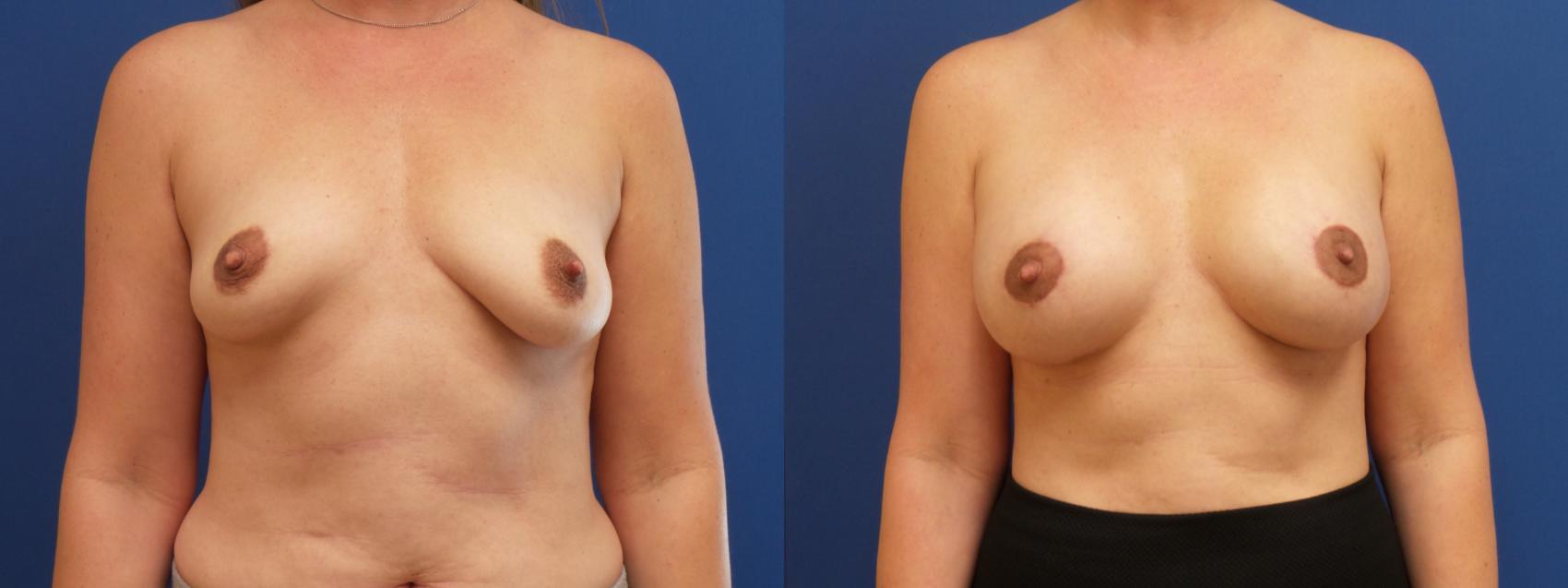 Breast Lift with Implants (Traditional & Donut) Case 193 Before & After View #1 | Webster, TX | Houston Plastic and Reconstructive Surgery