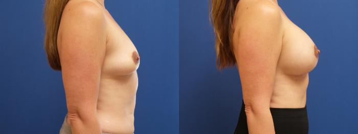 Breast Lift with Implants (Traditional & Donut) Case 193 Before & After View #2 | Webster, TX | Houston Plastic and Reconstructive Surgery